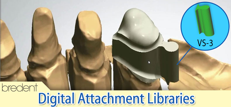 Bredent Medical y la tecnología CAD/CAM - Implantes dentales y prótesis ...