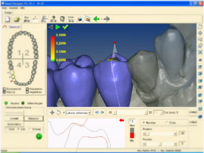 Bredent Medical y la tecnología CAD/CAM - Implantes dentales y prótesis ...