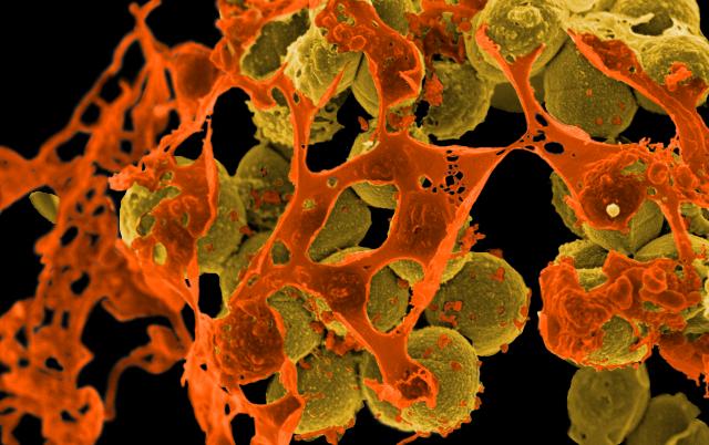 Staphylococcus aureus resistente a la meticilina o SARM