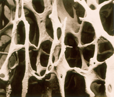 NRAS Osteoporosis